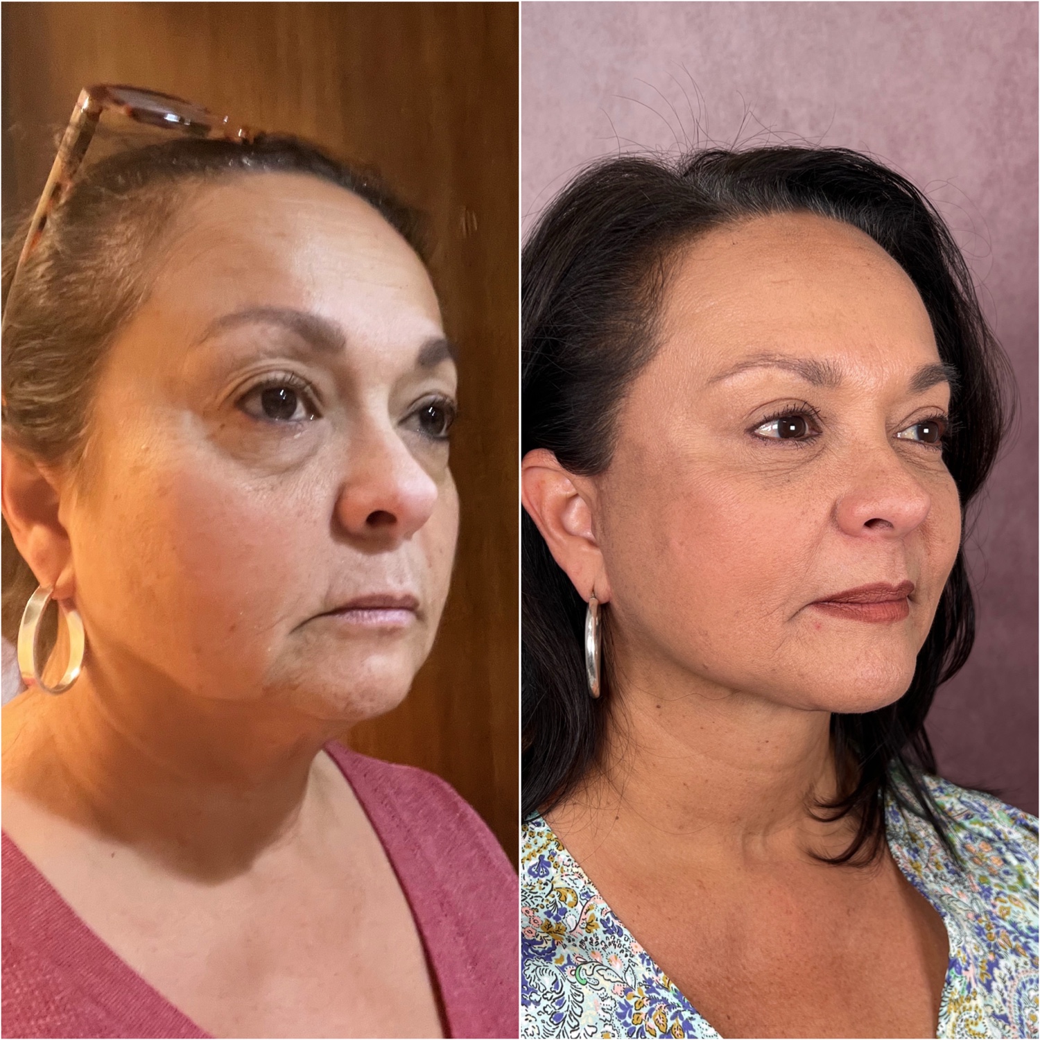 Before and after &mdash; deep neck lift as part of The Masterpiece, oblique view