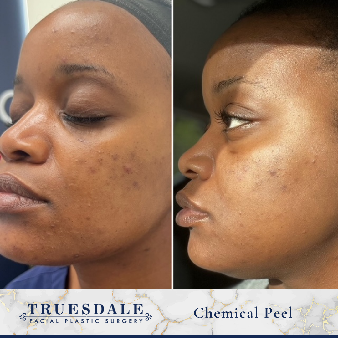 Chemical peel before and after · before and after composite