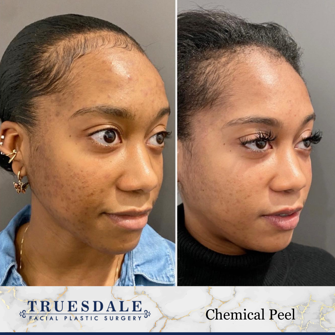 Chemical peel before and after · before and after composite