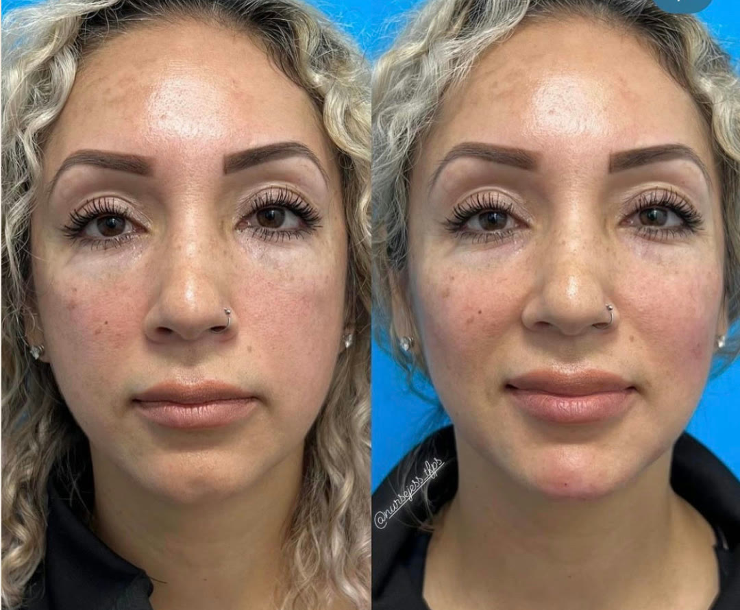 Chin and cheek filler before and after · before and after composite