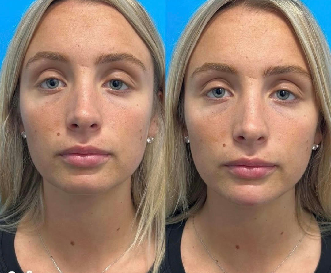 Chin filler before and after · before and after composite