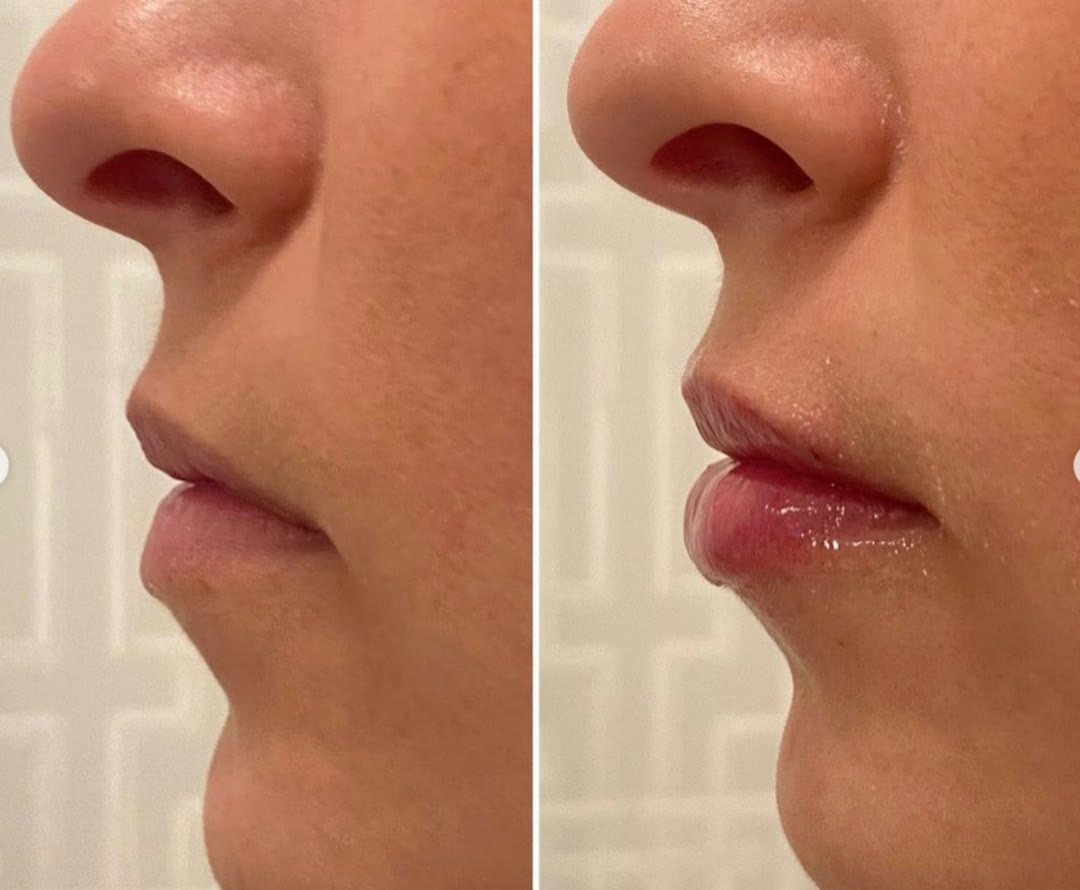 Lip filler before and after, profile view