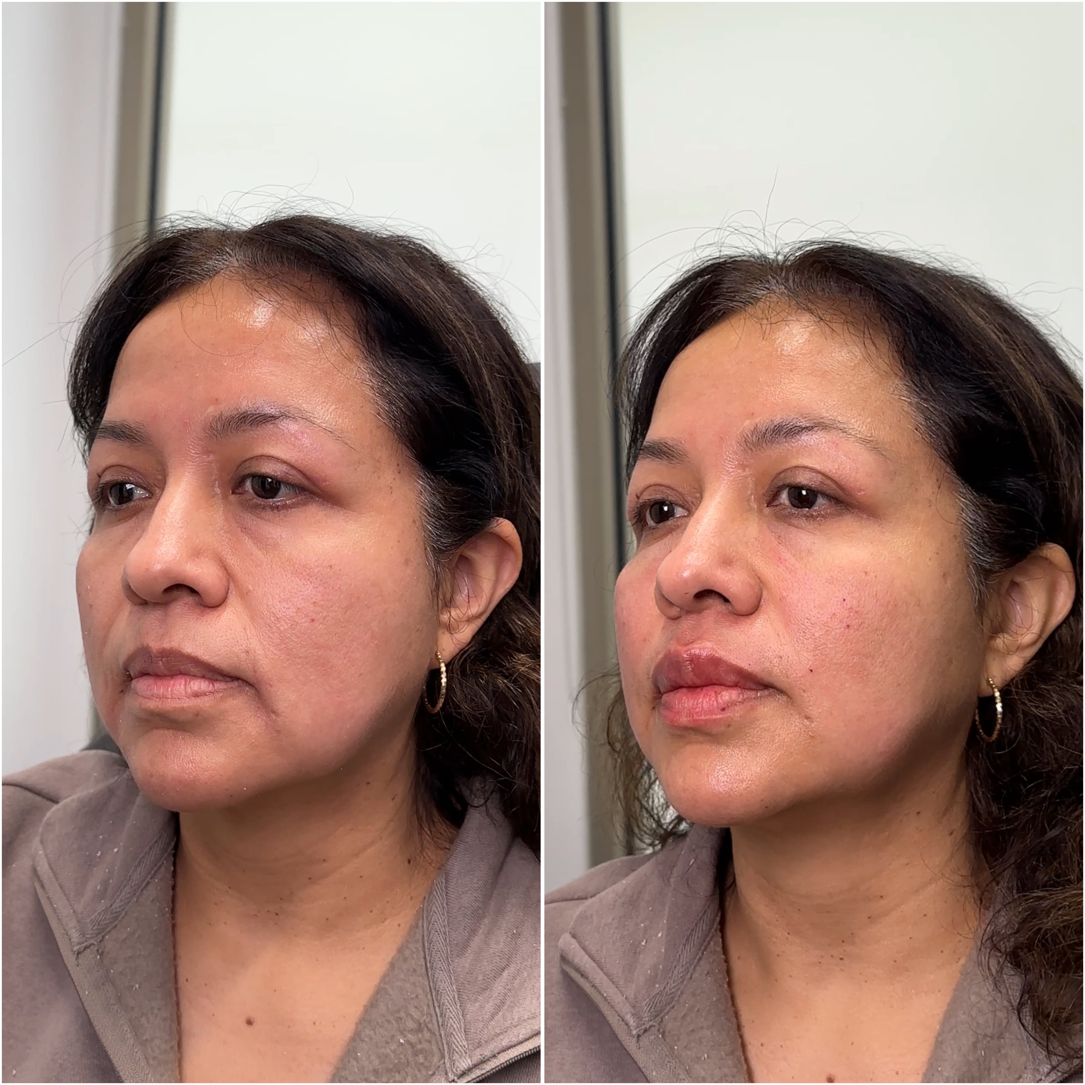 Dermal filler before and after · before and after composite