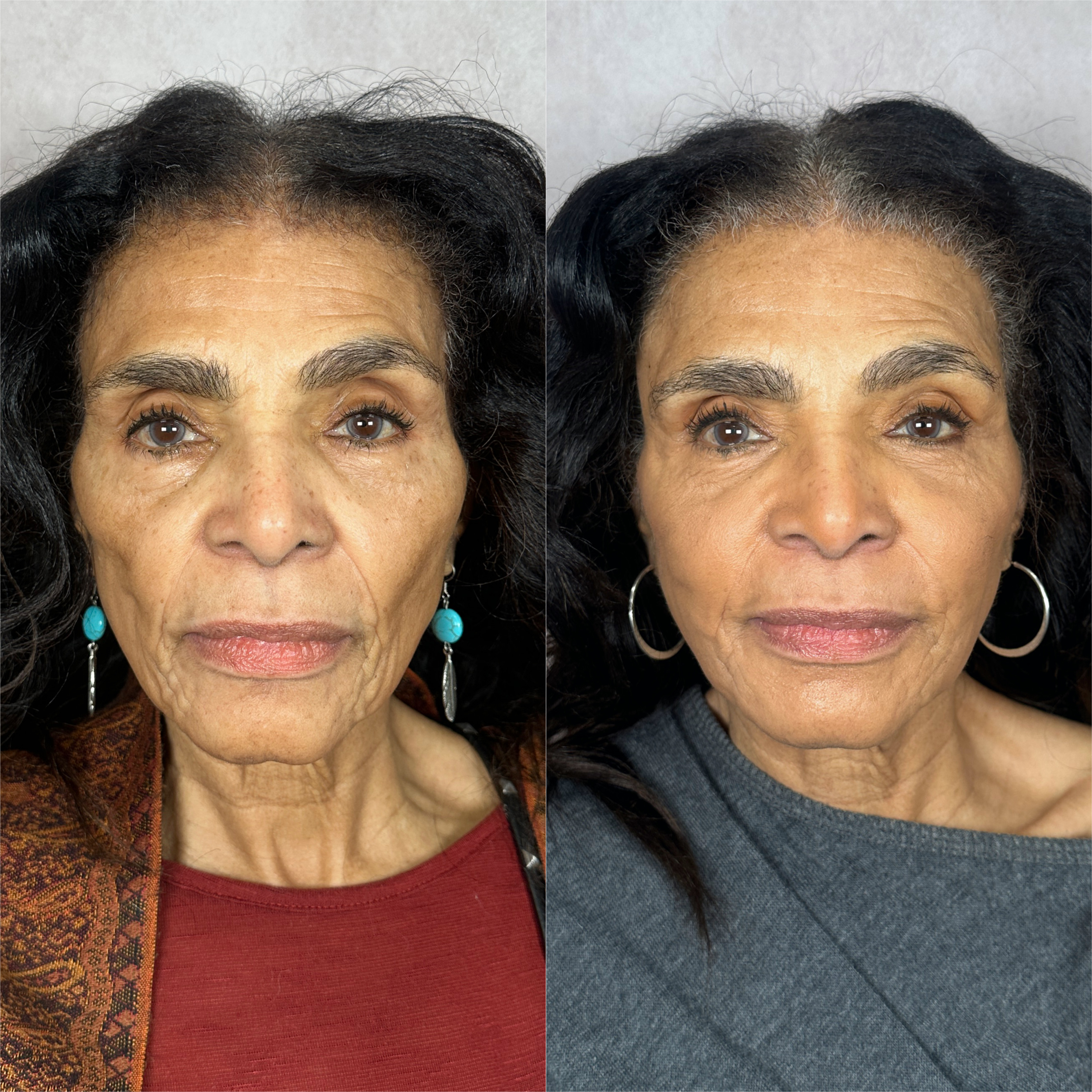 Dermal filler before and after · before and after composite