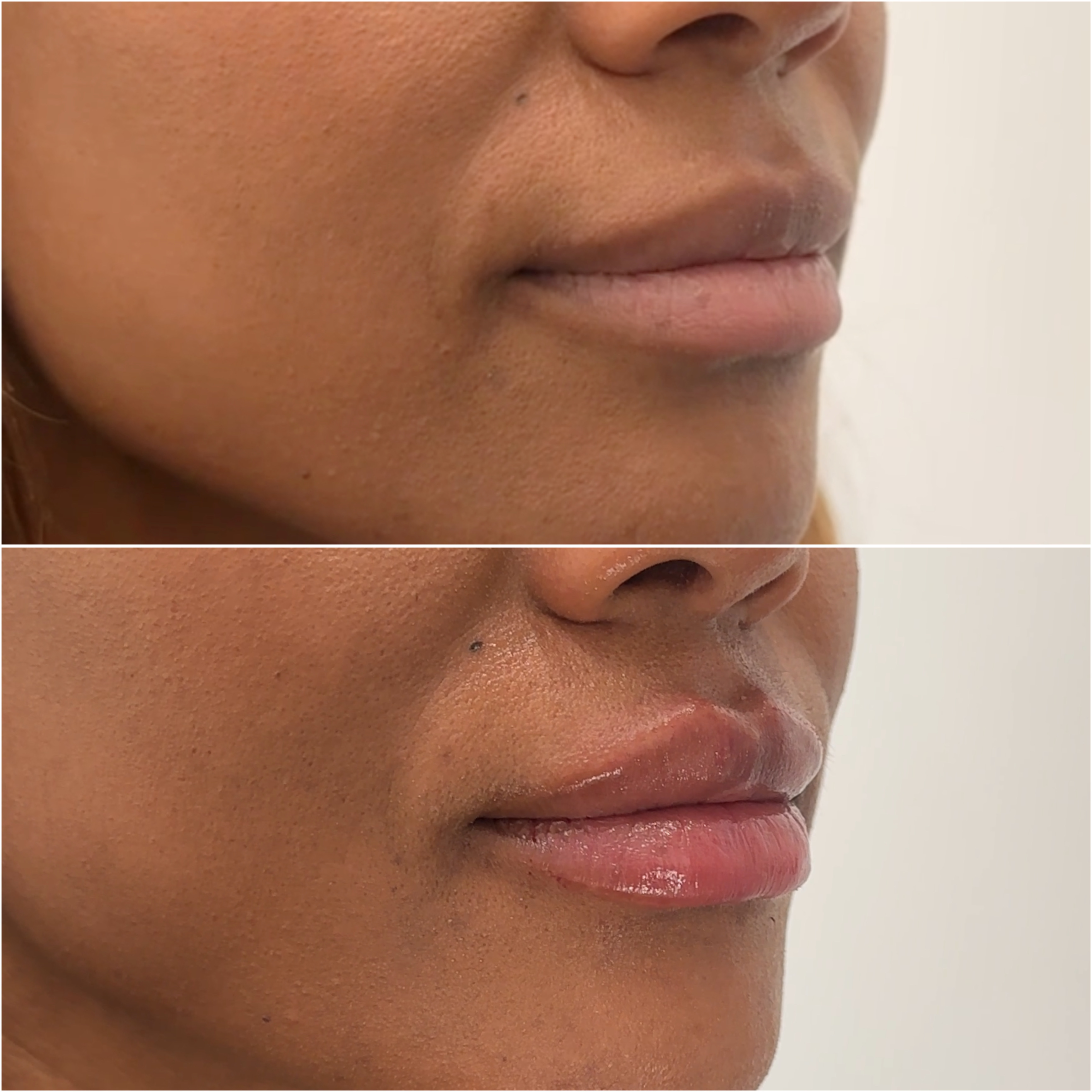 Filler before and after · before and after composite