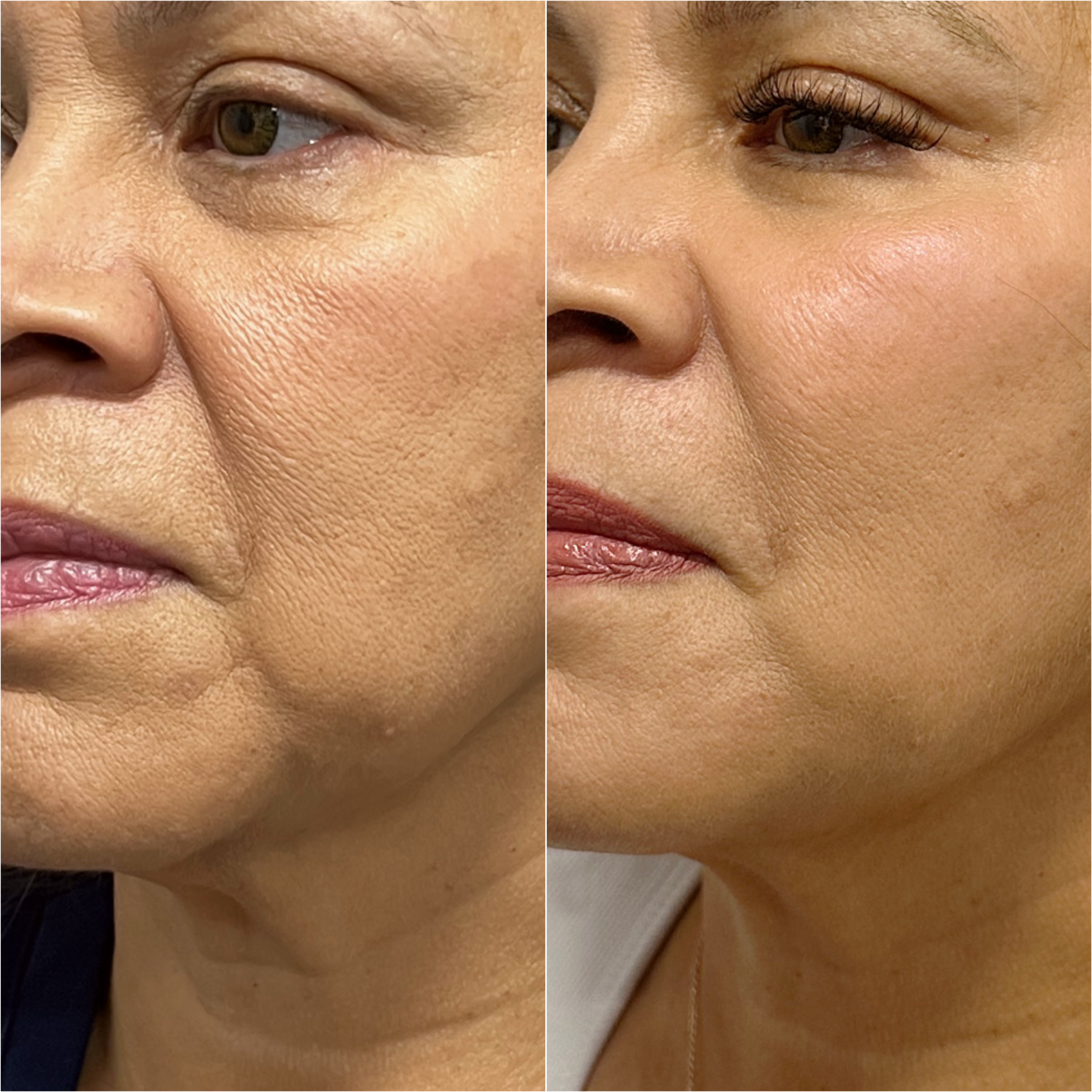 UltraClear laser before and after · before and after composite