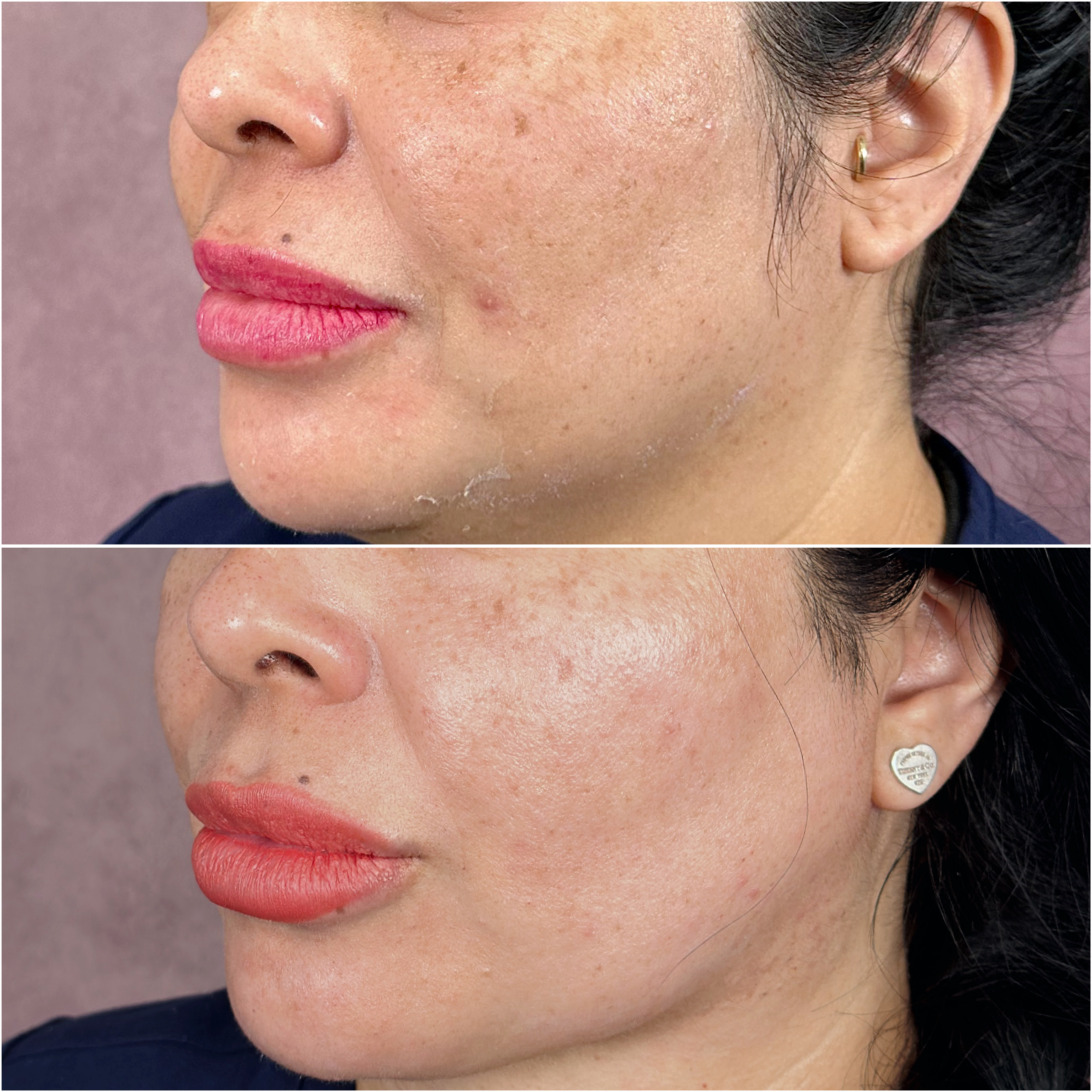 UltraClear laser before and after · before and after composite