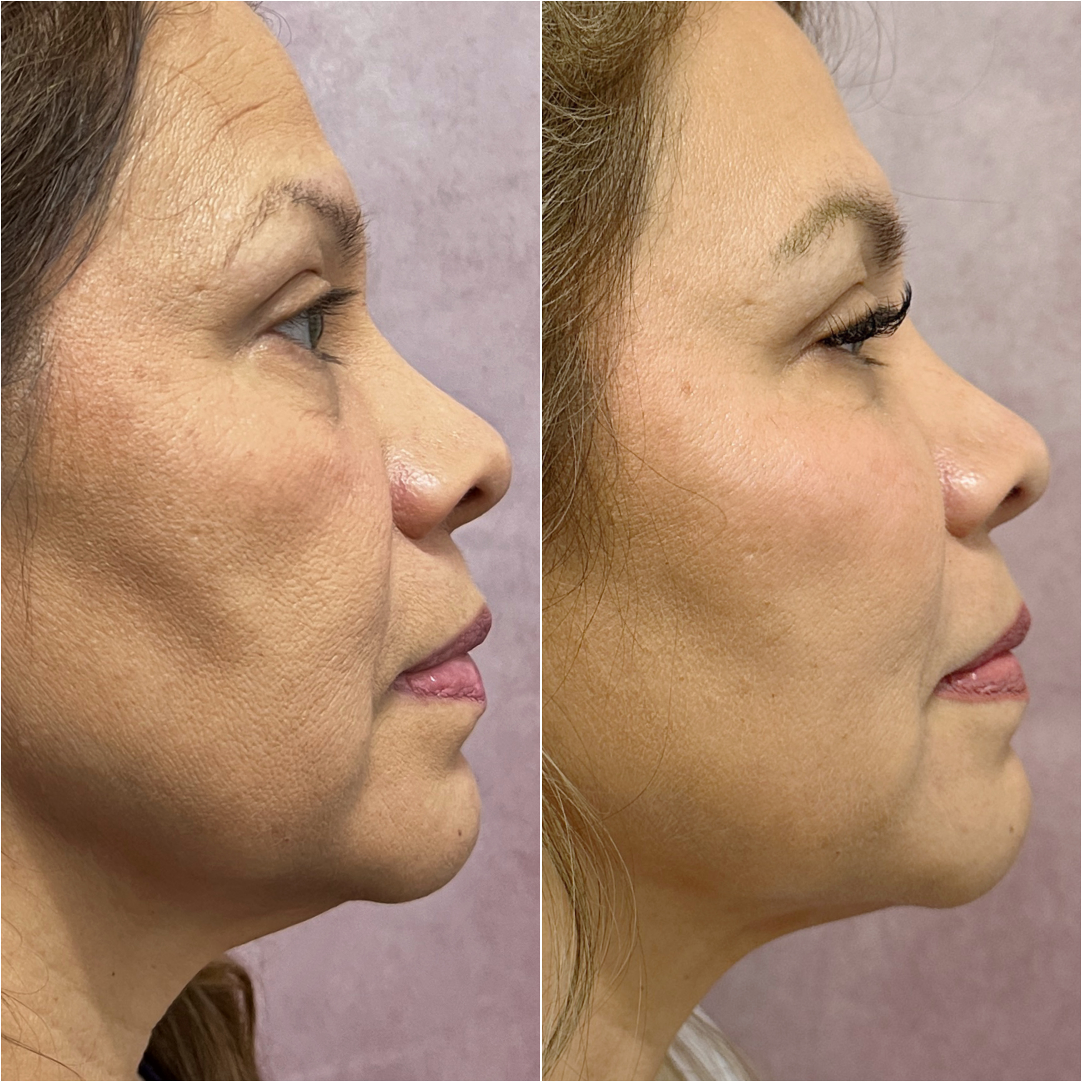 UltraClear laser before and after · before and after composite