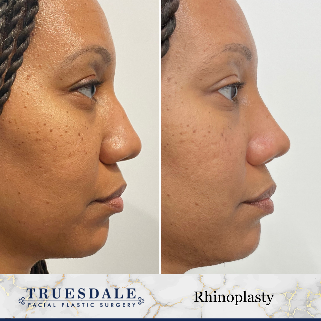 Before and after — rhinoplasty, profile view