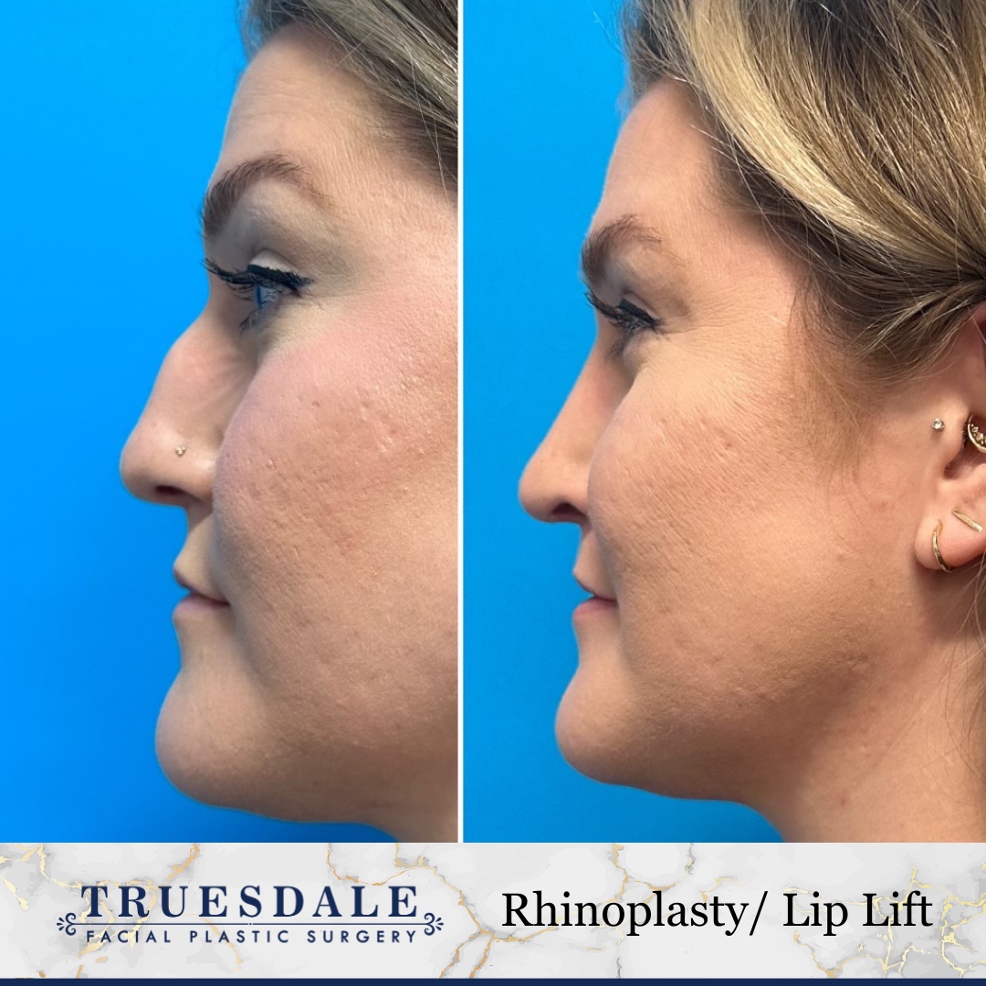 Before and after &mdash; rhinoplasty and lip lift, profile view