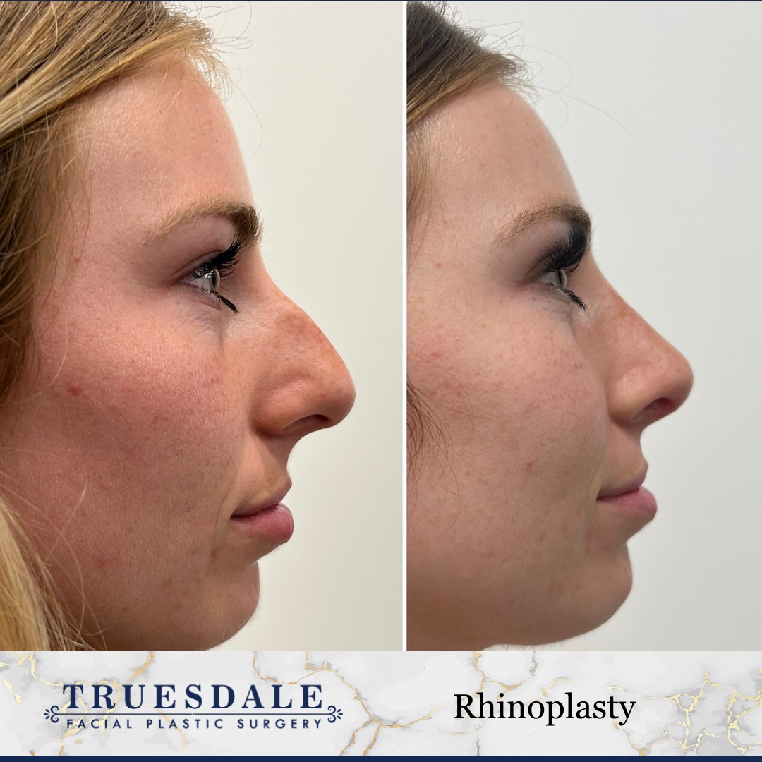 Before and after &mdash; rhinoplasty, profile view