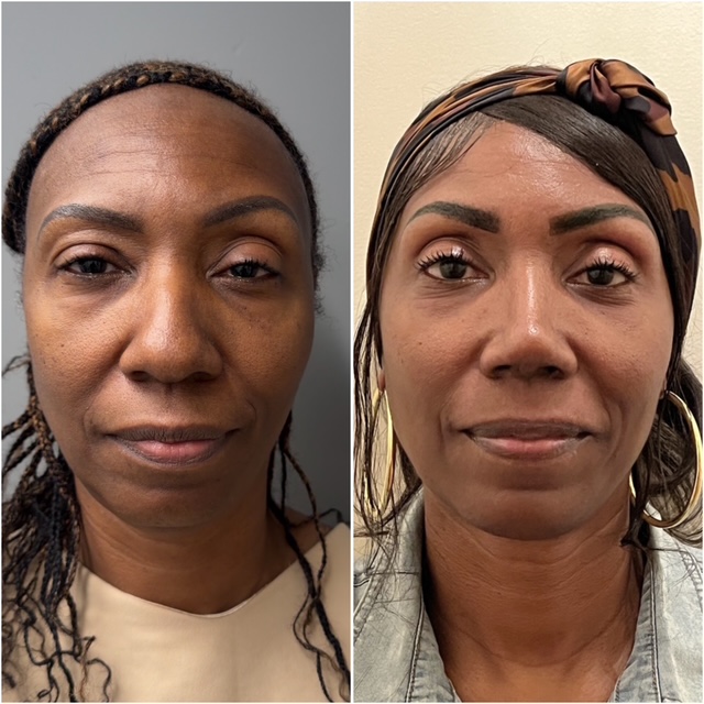 Before and after &mdash; rhinoplasty, frontal view