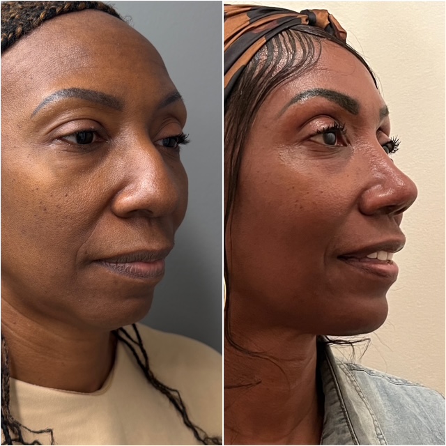 Before and after &mdash; rhinoplasty, oblique view