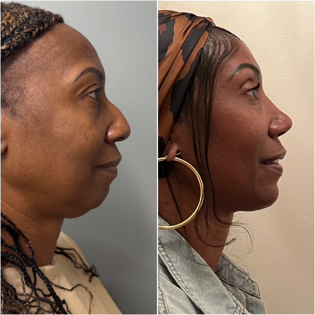 Before and after &mdash; rhinoplasty, profile view