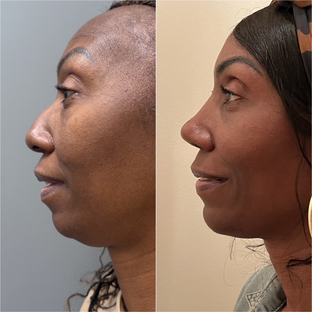 Before and after &mdash; rhinoplasty, profile view