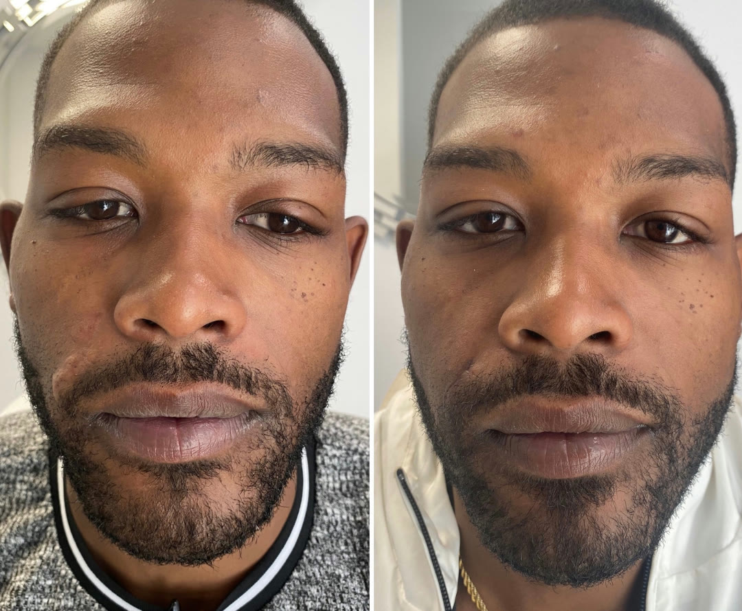 Scar revision before and after &mdash; male facial scar revision · before and after composite