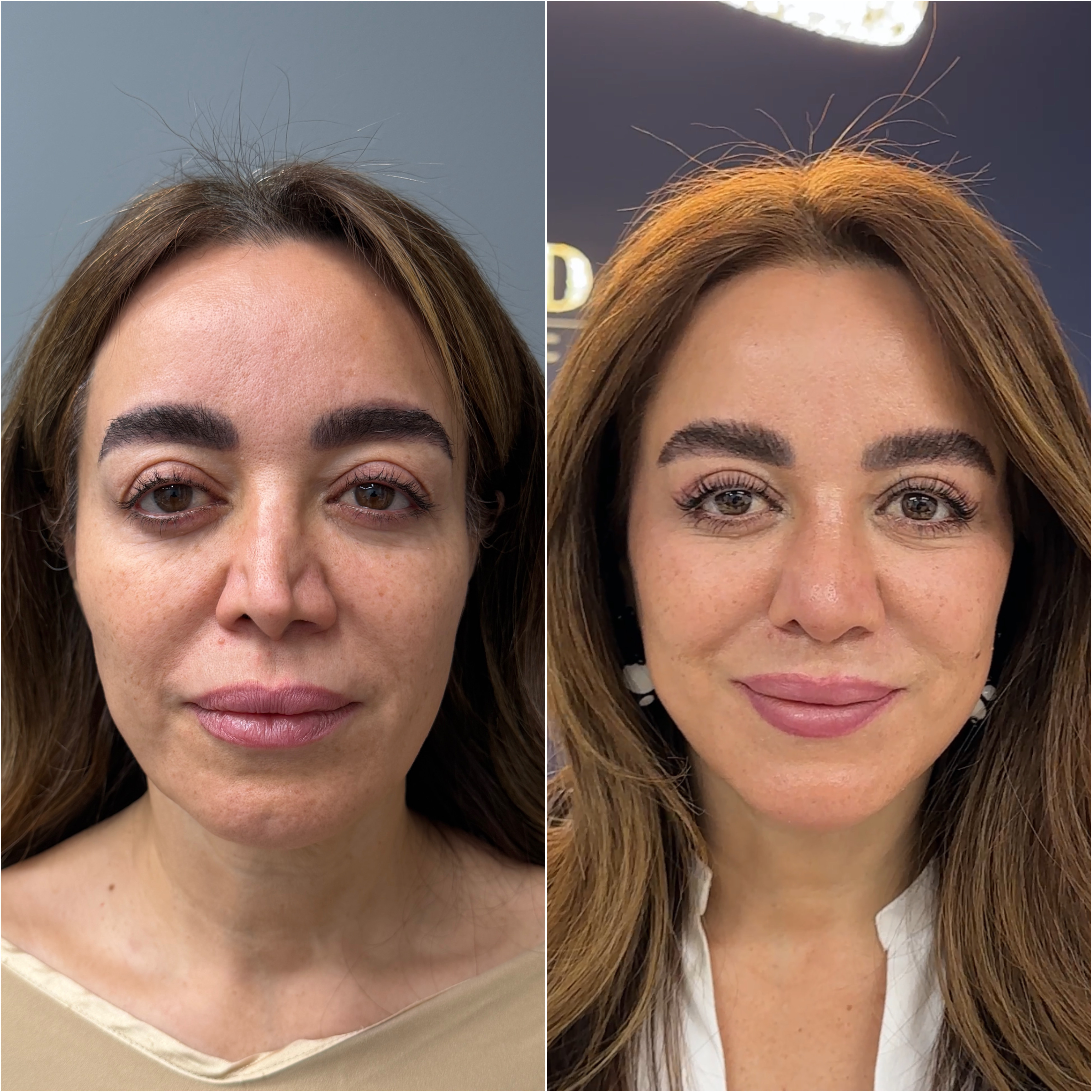 Rhinoplasty before and after &mdash; refined tip &middot; frontal