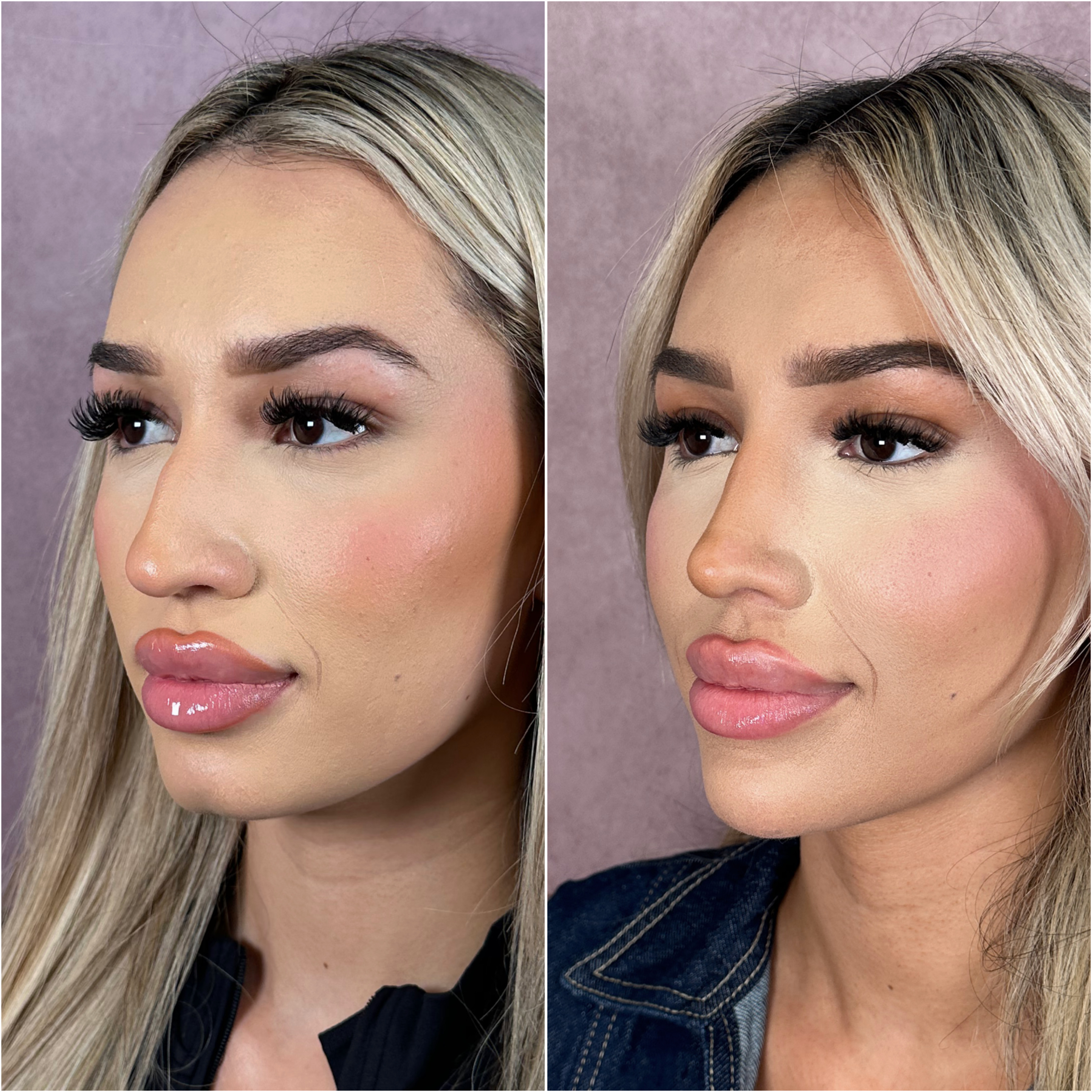 Rhinoplasty before and after &mdash; refined tip definition &middot; three-quarter view