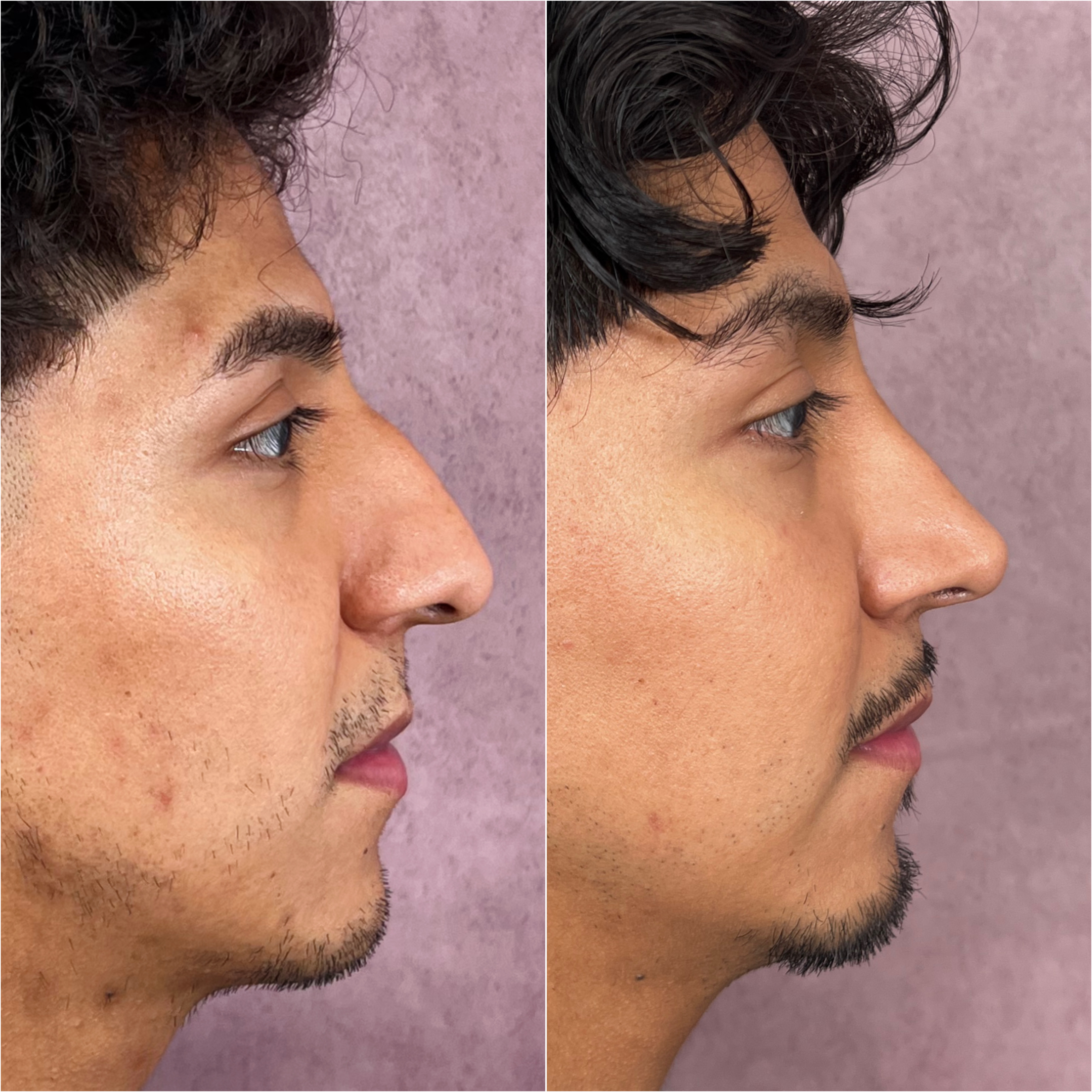 Rhinoplasty before and after &mdash; male rhinoplasty &middot; dorsal refinement