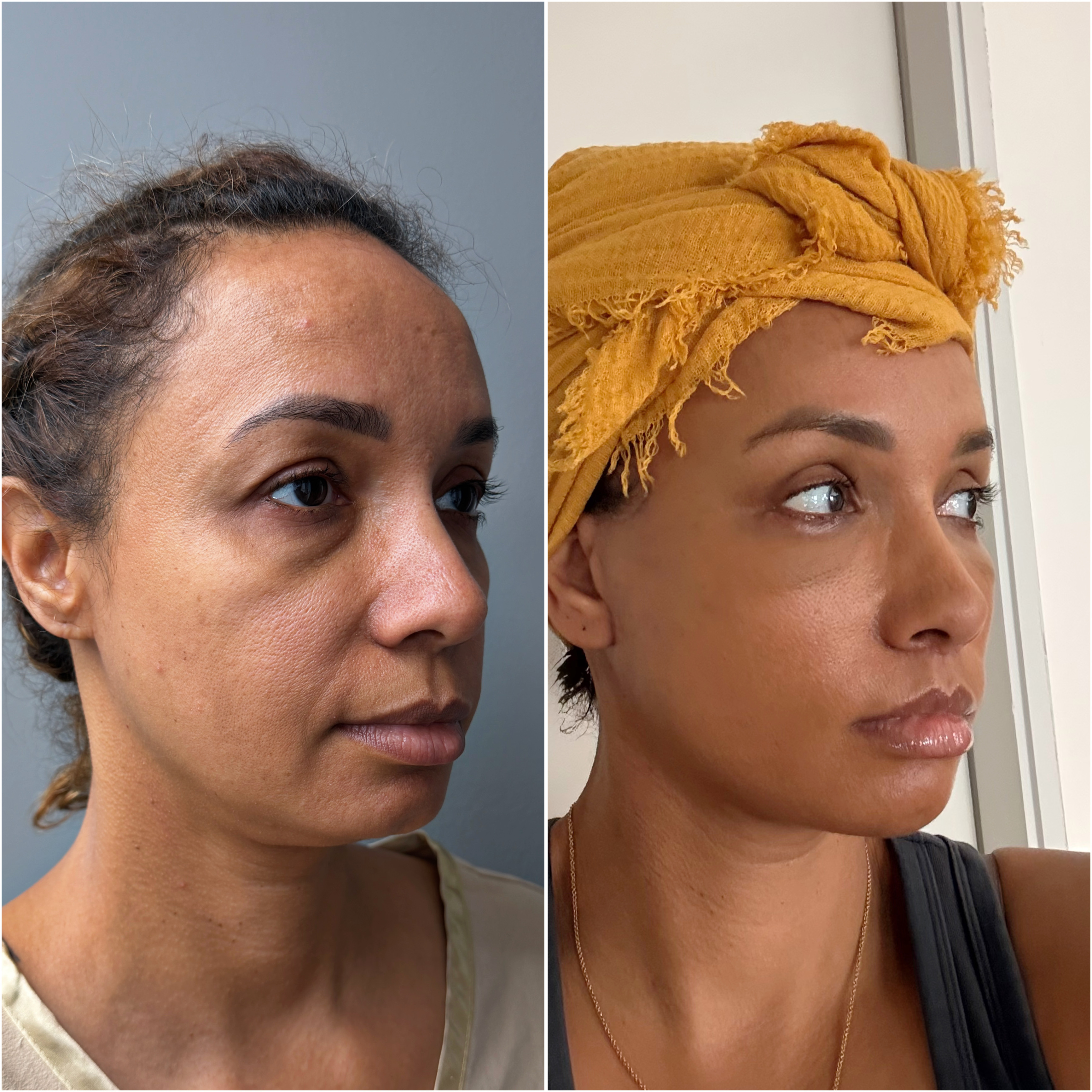 Upper blepharoplasty before and after &mdash; opened upper lid, brighter eye area